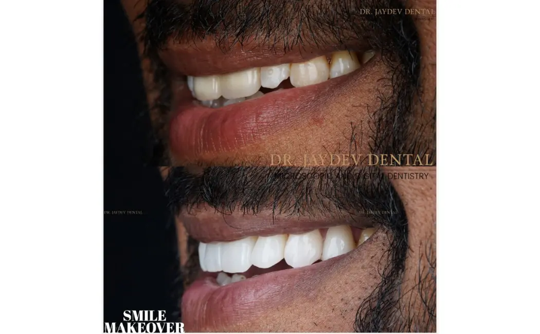 best smile designing treatement before after